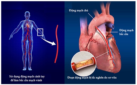 Phẫu thuật bắc cầu mạch vành